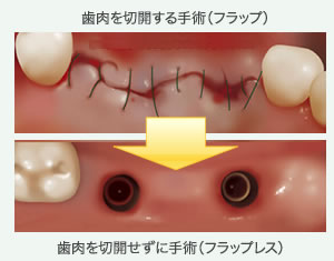 フラップレス手術