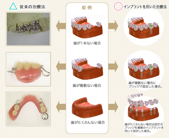 インプラントの治療法