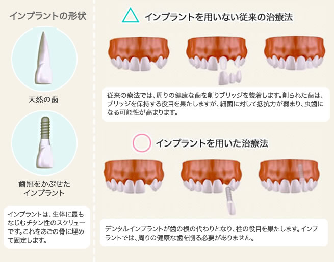 人工の根で固定するインプラント